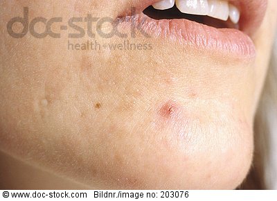 staphylococcus aureus cutis dermatologie